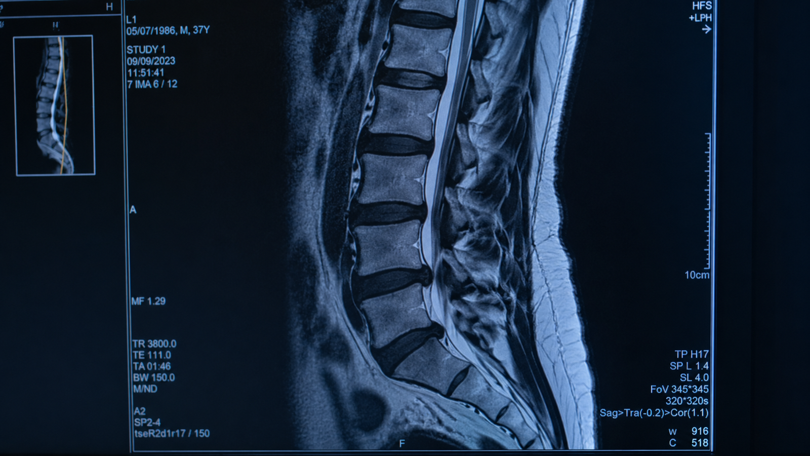 Prótese discal cervical e plano de saúde: cobertura obrigatória após inclusão no Rol da ANS em 2026