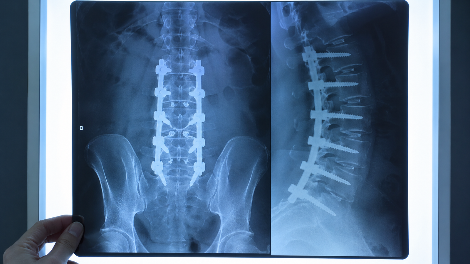 Cirurgia minimamente invasiva de coluna negada pelo plano de saúde