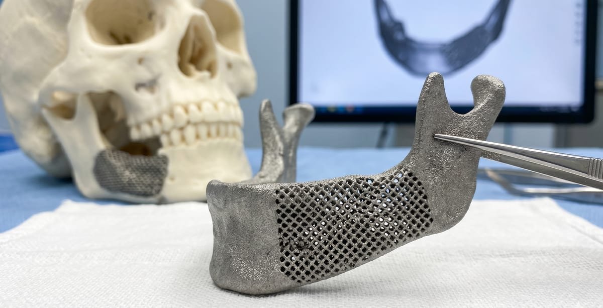 Prótese mandibular customizada impressa em 3D (CAD-CAM), OPME de cobertura controversa